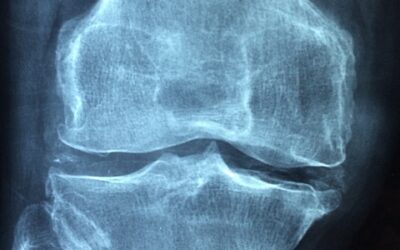 Was bedeutet Arthrose und was kann man dagegen machen?